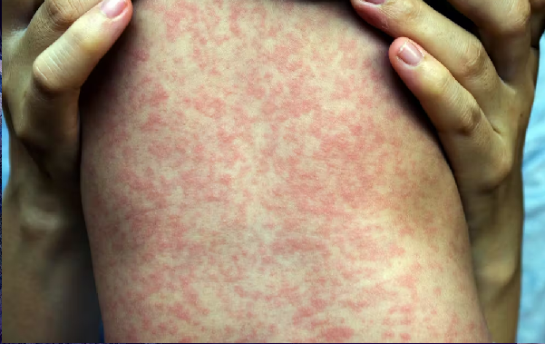 Otra epidemia, Rep. Dominicana emite alerta epidemiológica por sarampión