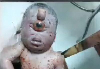 Vicente Noble: ¡Extraño! Nace bebé con un sólo ojo en el centro de su rostro