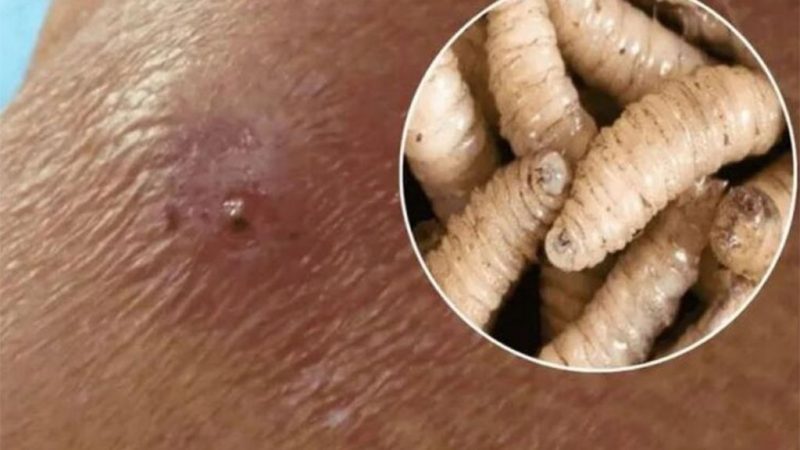 Detectan segundo caso humano miasis gusano barrenador en México