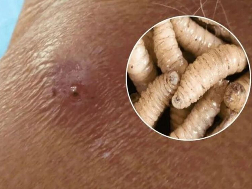 Detectan segundo caso humano miasis gusano barrenador en México