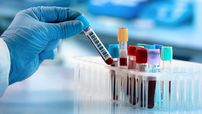 Nuevo análisis de sangre mejora la detección del cáncer de próstata agresivo, según estudio