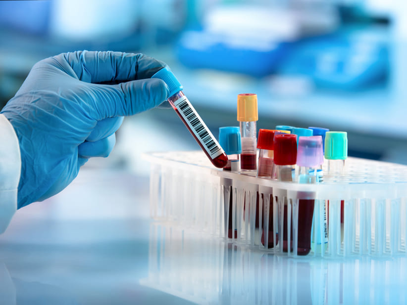 Nuevo análisis de sangre mejora la detección del cáncer de próstata agresivo, según estudio